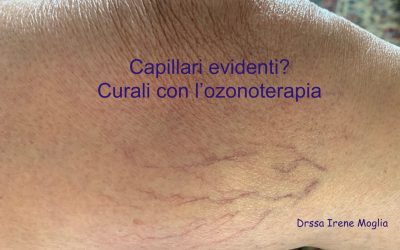 I capillari evidenti possono essere curati con l’ozonoterapia